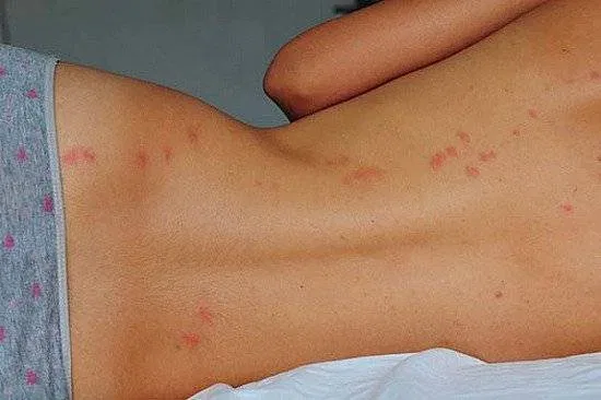 Best Home Remedies for Bed Bug Bite Relief