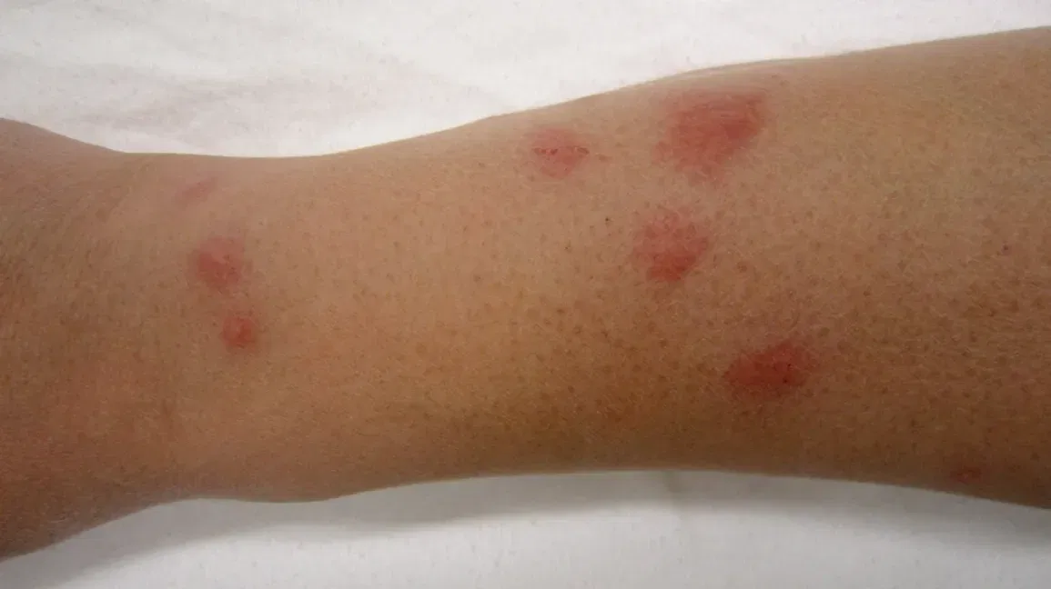 How to Prevent Bed Bug Bites While Traveling