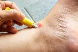 How to Reduce Mosquito Bite Marks