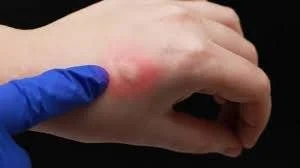 Mosquito Bite Infection Signs