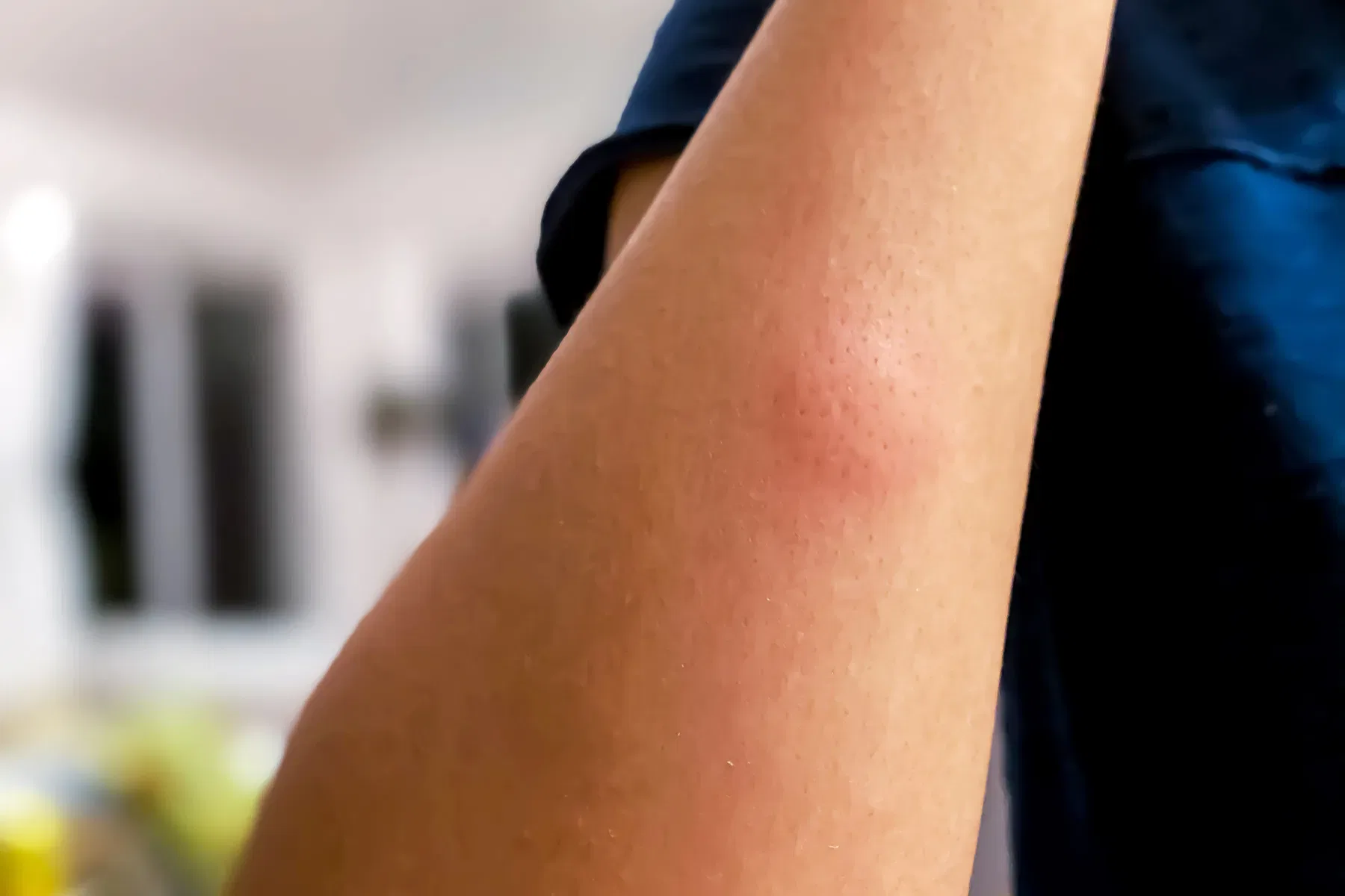 Swollen Mosquito Bite Treatment