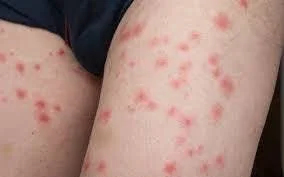 When to See a Doctor for Bed Bug Bite Reactions