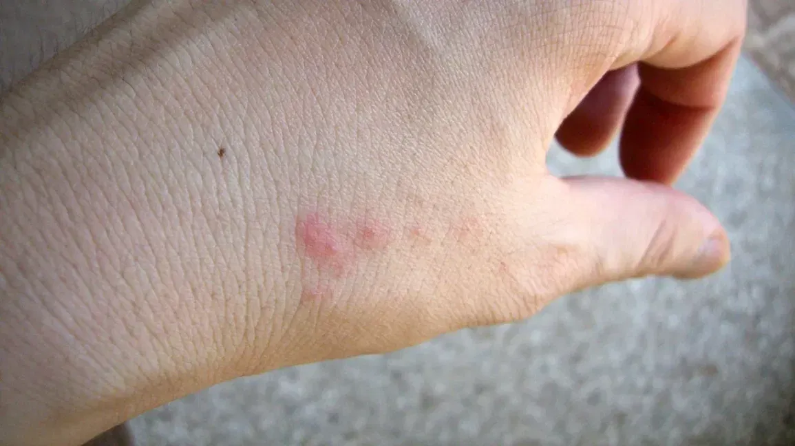 Why Do Bed Bug Bites Itch So Much
