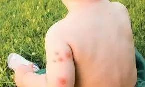 How to Treat Mosquito Bites on Toddlers