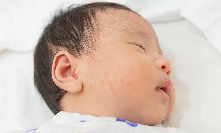 Bed Bug Bites on Baby Treatment