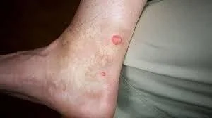 Bites Only on Ankles and Lower Legs