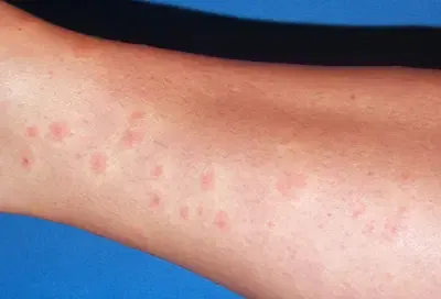 Carpet Beetle Rash