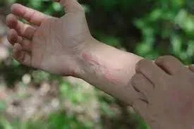 Does Rubbing Alcohol Help Poison Ivy
