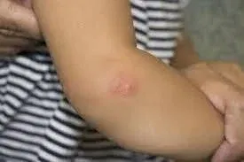 Mosquito Bite Blisters Treatment