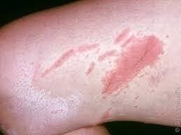 How Long Does Poison Ivy Last