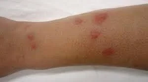 How Long for Bed Bug Bites to Heal