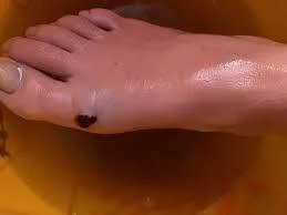 How to Treat a Stingray Sting