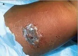 How to Treat an Infected Spider Bite Safely