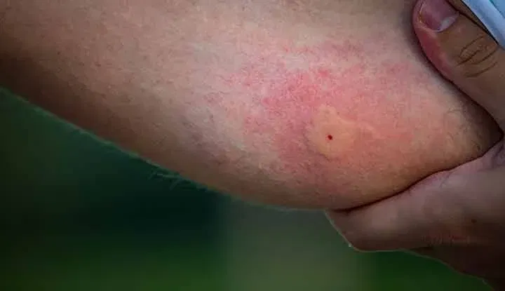 Mosquito Bite Marks on Skin Removal