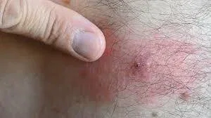 Mosquito Bite Itch Relief Natural Oils