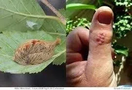 Puss Caterpillar Sting Treatment
