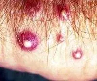Pustules from Fire Ant Bites