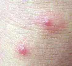 Scabies vs Chigger Bites