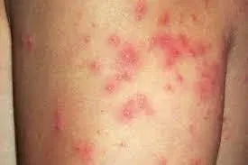 How to Get Rid of Poison Ivy Rash Fast