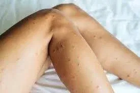 Bites Only on Ankles and Lower Legs