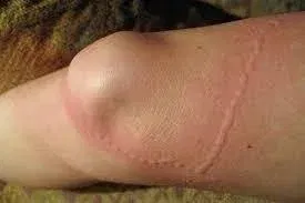 How to Get Rid of Poison Ivy Rash Fast