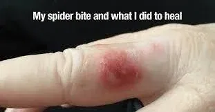 Spider Bite Won’t Heal