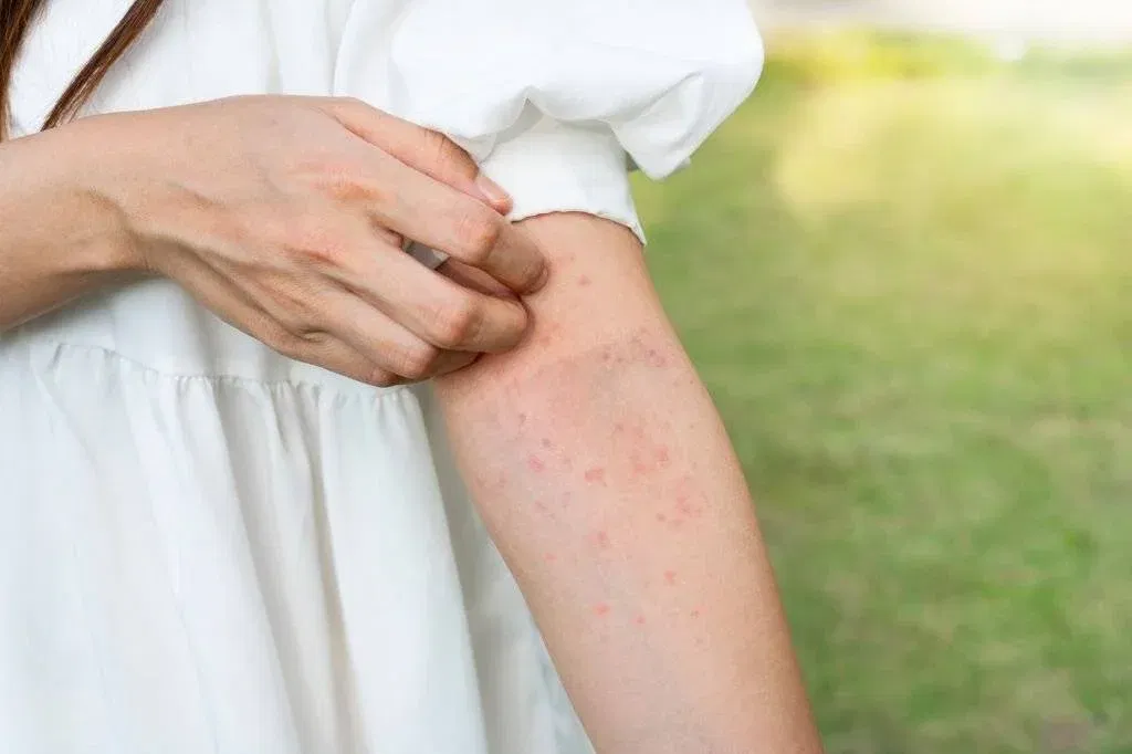 Stress Rash vs Bug Bites