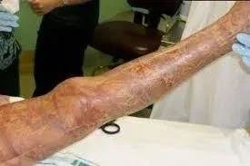 How to Treat a Stingray Sting