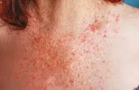 Tiny Red Dots on Stomach Not Itchy