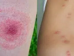 What’s Biting Me in My Garden