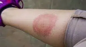 Large Local Reaction to Wasp Sting