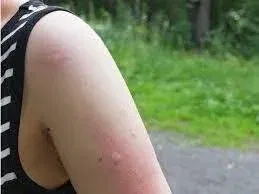 When to See a Doctor for a Bug Bite