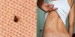 How to Get Rid of Bug Bite Scars