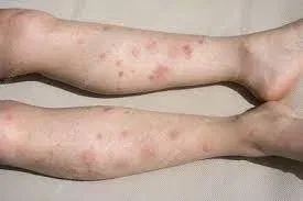 Allergic Reaction to Mosquito Bite Treatment