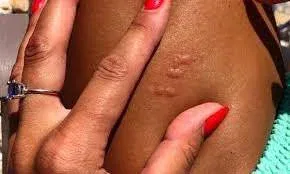 Anaphylaxis From Bee Sting Timeline