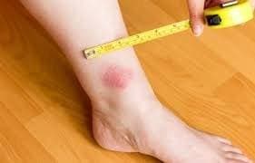 bites around ankles and lower legs