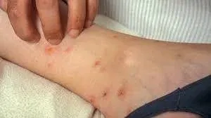 bites around ankles and lower legs