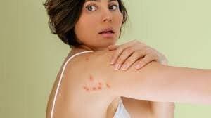 bites on arms and shoulders