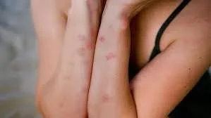 bites on arms and shoulders