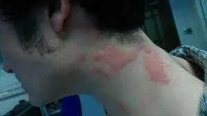 Best Anti Itch Cream for Bug Bites