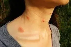 Bites on Face and Neck Only