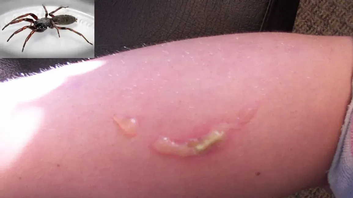 bug bite is rock hard and hot