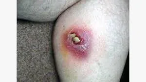Bug Bites That Swell Up Like a Knot