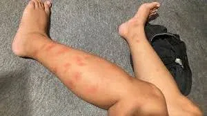 Can You Put Rubbing Alcohol on a Bug Bite