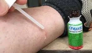 chigger bites treatment and duration