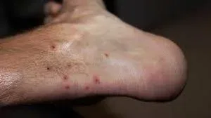 Chiggers vs Hives on Ankles