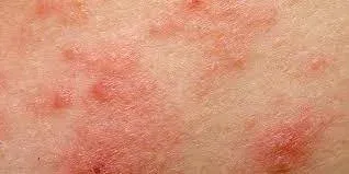 Contact Dermatitis vs Insect Bites
