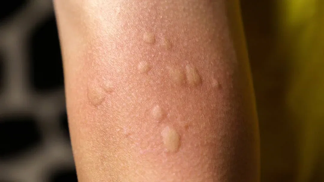 delayed allergic reaction to mosquito bite