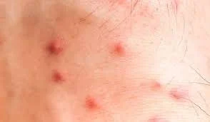 Flea Bites on Humans vs Mosquito Bites