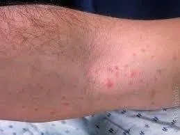 Folliculitis vs Bug Bites on Legs